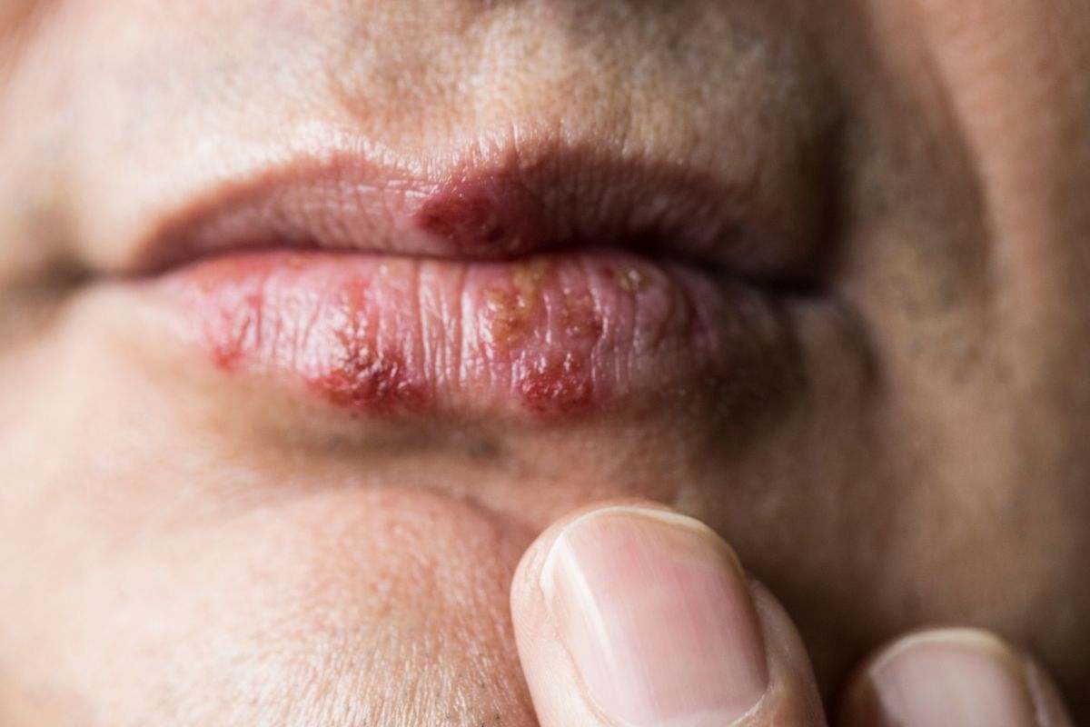 Herpes labiale, tutte le possibili cause e come curarlo