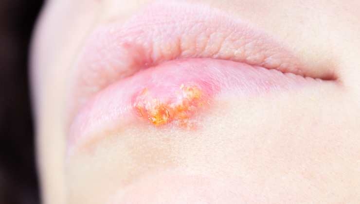 Herpes labiale, quali sono le cause e come curarlo