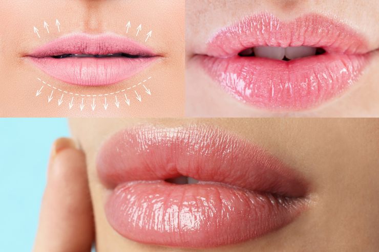 Labbra carnose: come ottenere l'effetto filler
