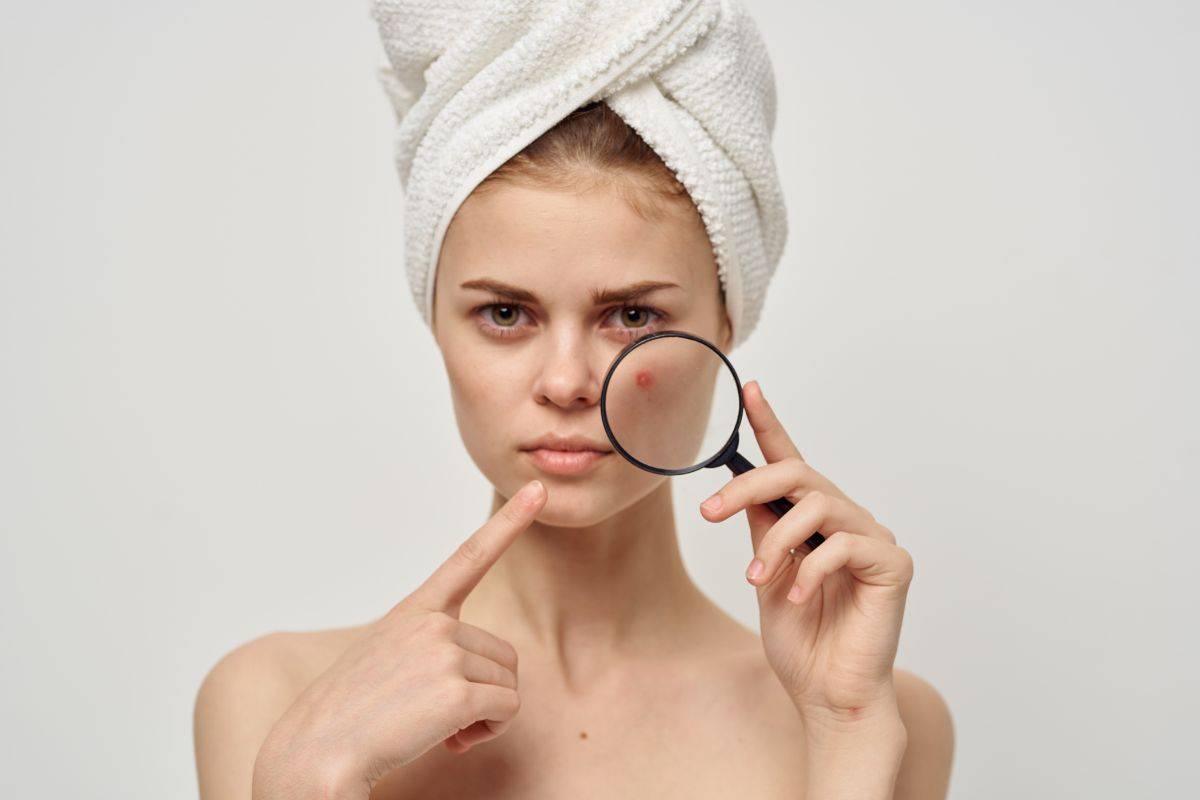 Come nascondere un brufolo con il make-up: questo è il colore di correttore da scegliere per renderlo invisibile