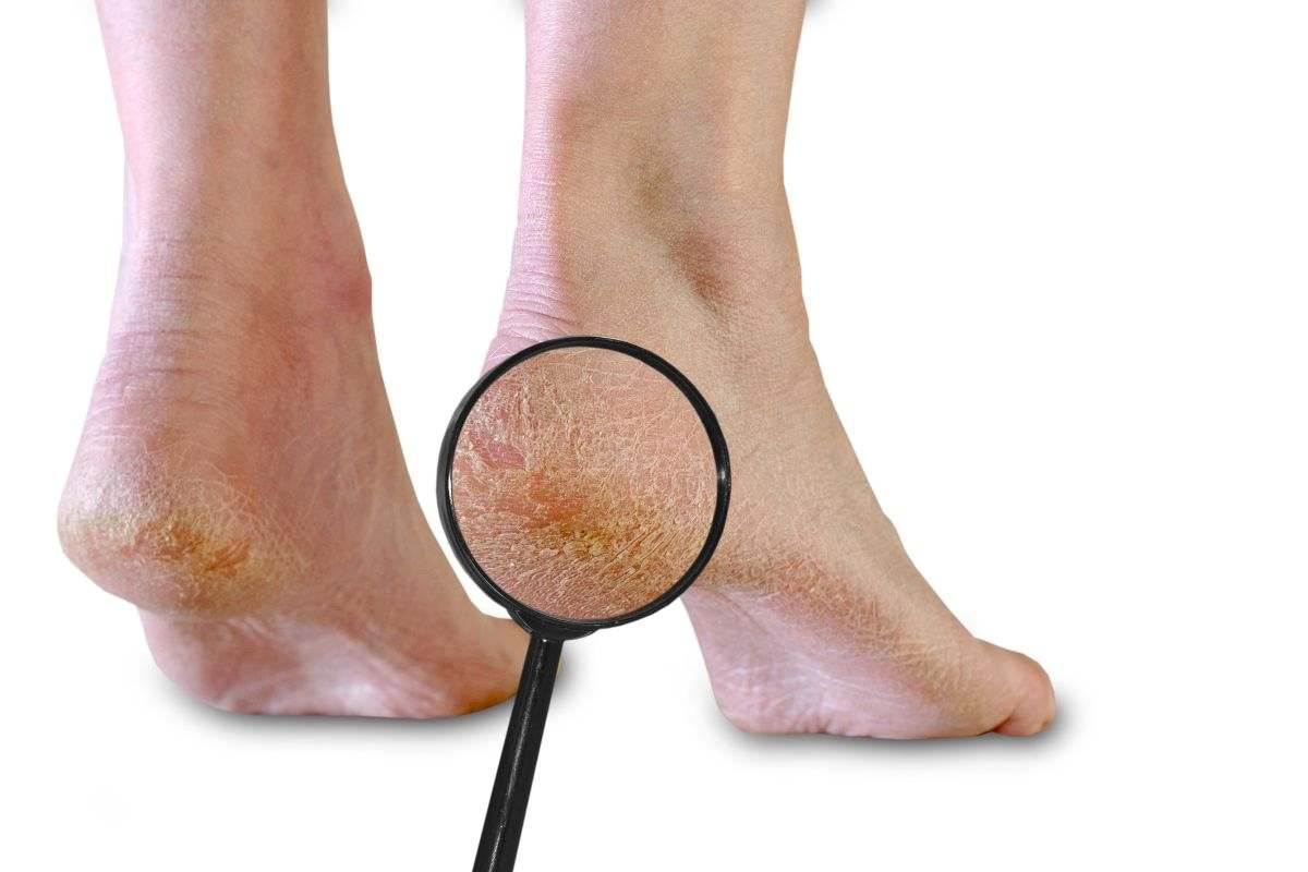 Mai più talloni secchi e duri: la ricetta ecologica a base di curcuma per piedi morbidissimi