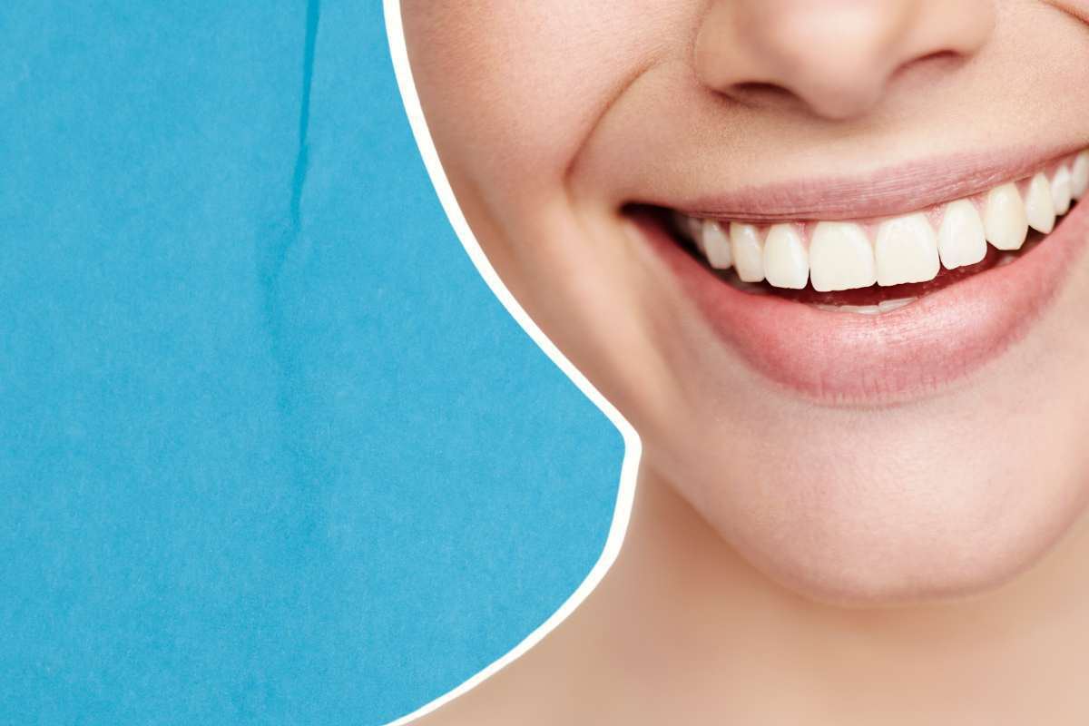 Sorriso perfetto in poche mosse? Cosa sono le faccette dentali, chi può applicarle e come funzionano