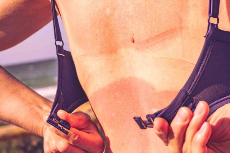 rimedi per prevenire le scottature