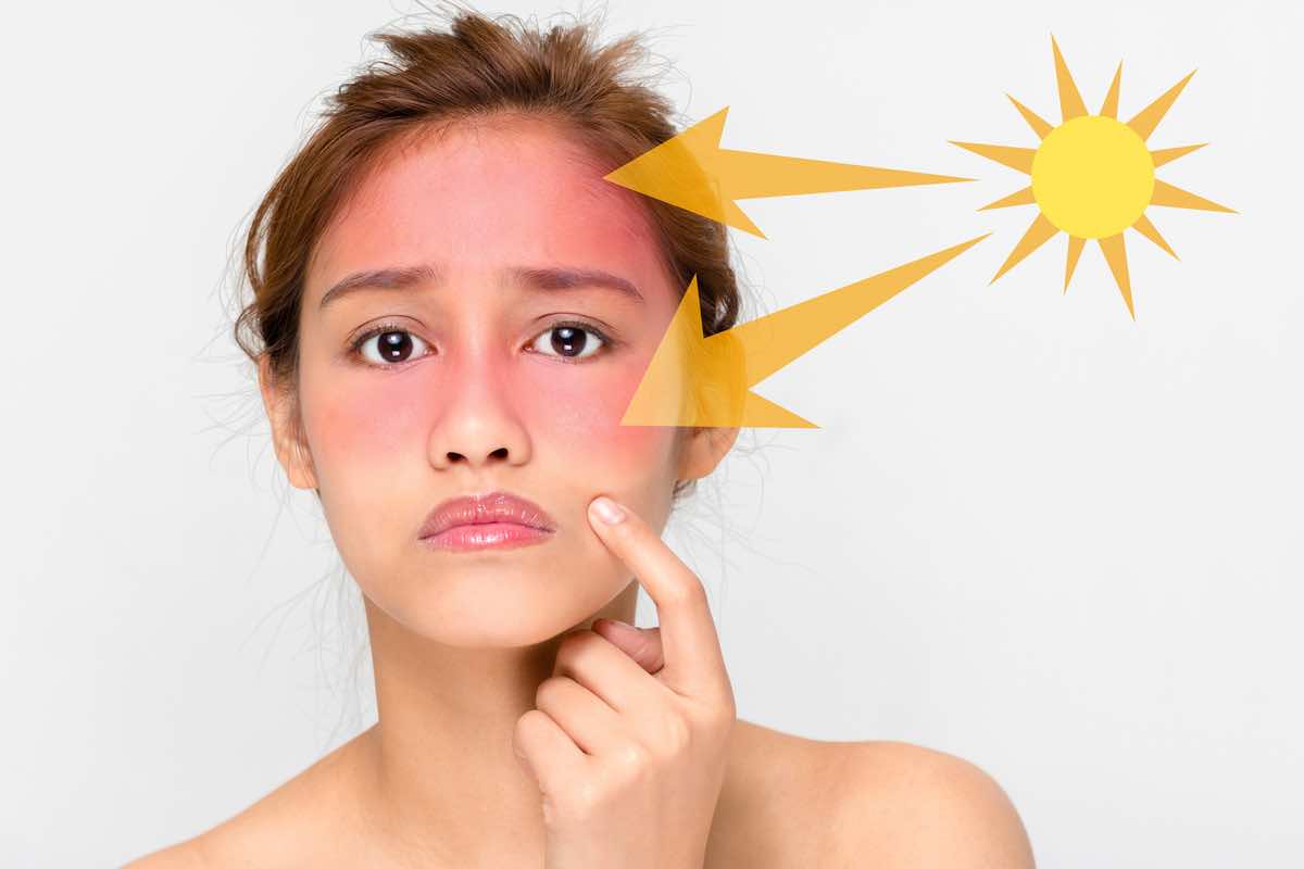 Scottatura solare: come si può intervenire per alleviare il dolore