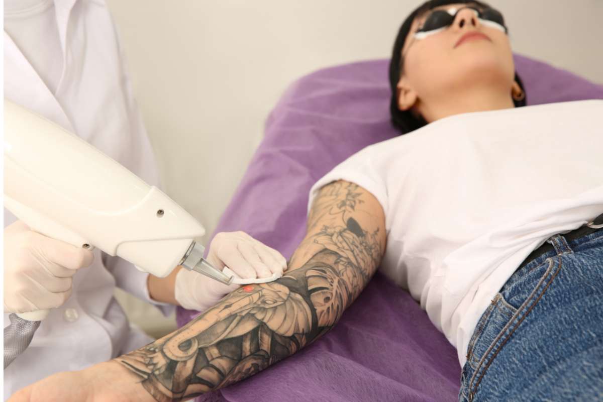 rimozione del tatuaggio con laser: come funziona, quanto tempo occorre e quando farla