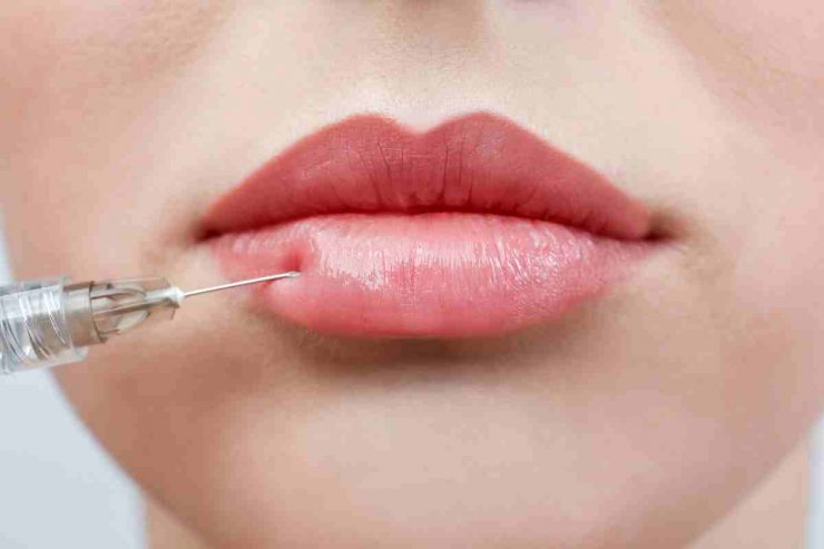 trattamento filler labbra