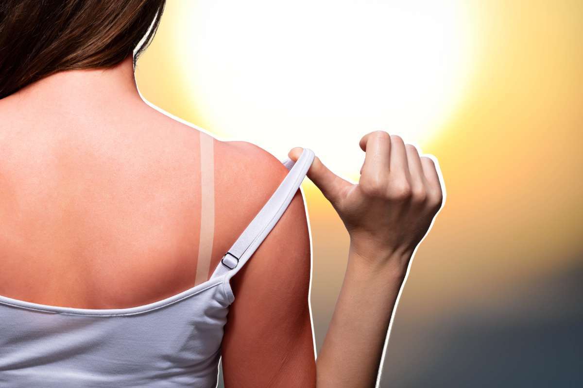 Pelle ustionata dal sole: gli errori più diffusi che peggiorano la situazione, attenzione a non farli