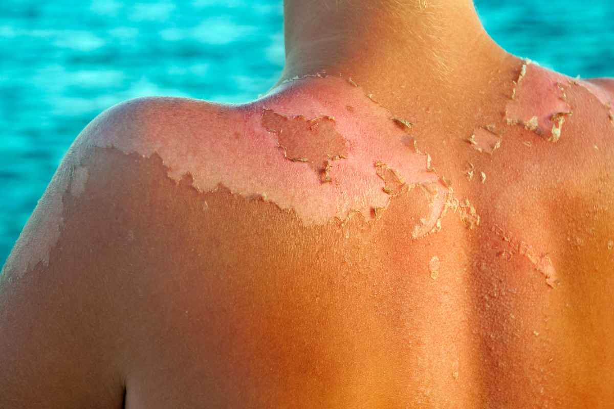 L’abbronzatura inizia a “spellare”? Come evitare di rovinarsi la tintarella: prevenire e risolvere il problema