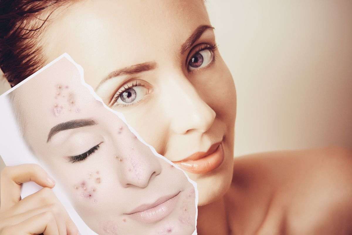 Come eliminare le macchie scure sul viso: i trattamenti definitivi