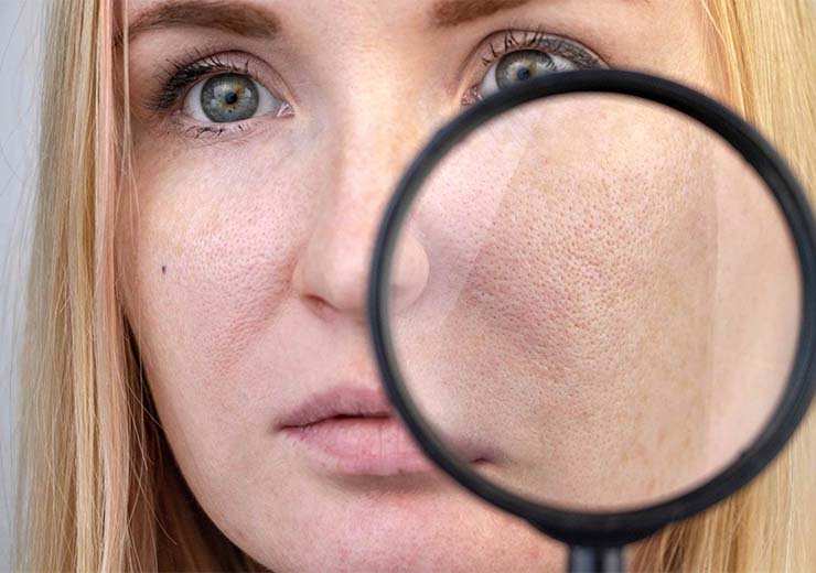 Skin Icing per ridurre i pori dilatati