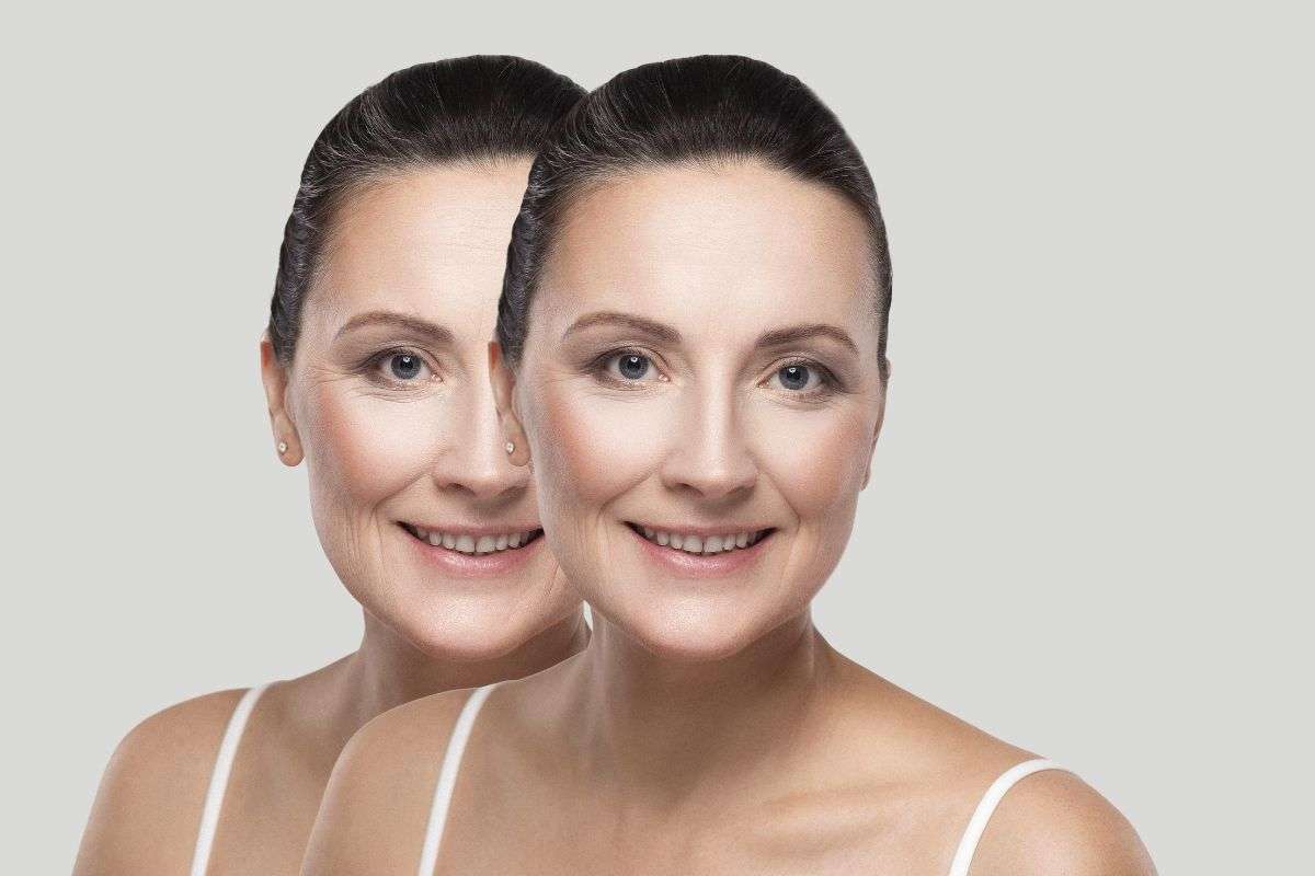 Botox: gli effetti collaterali della puntura di tossina sul viso per ridurre i segni del tempo