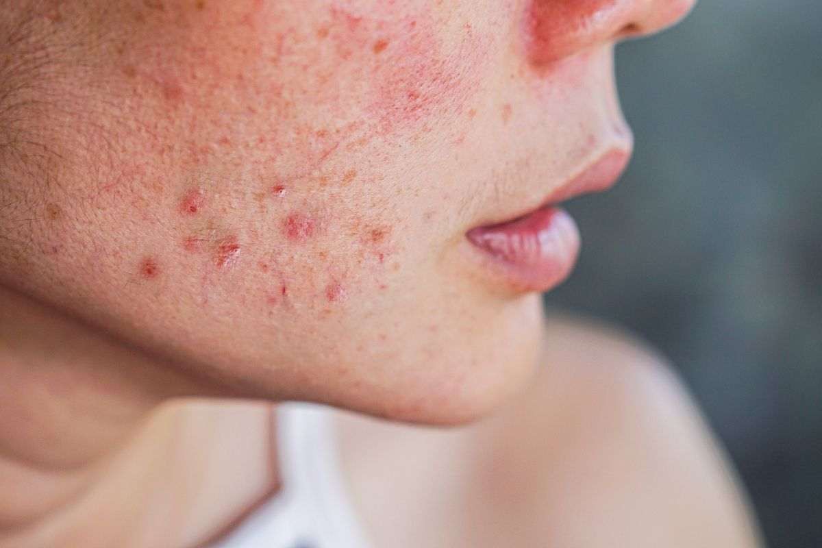 Chi ha l’acne deve evitare assolutamente questi 6 errori col make up: effetto pessimo