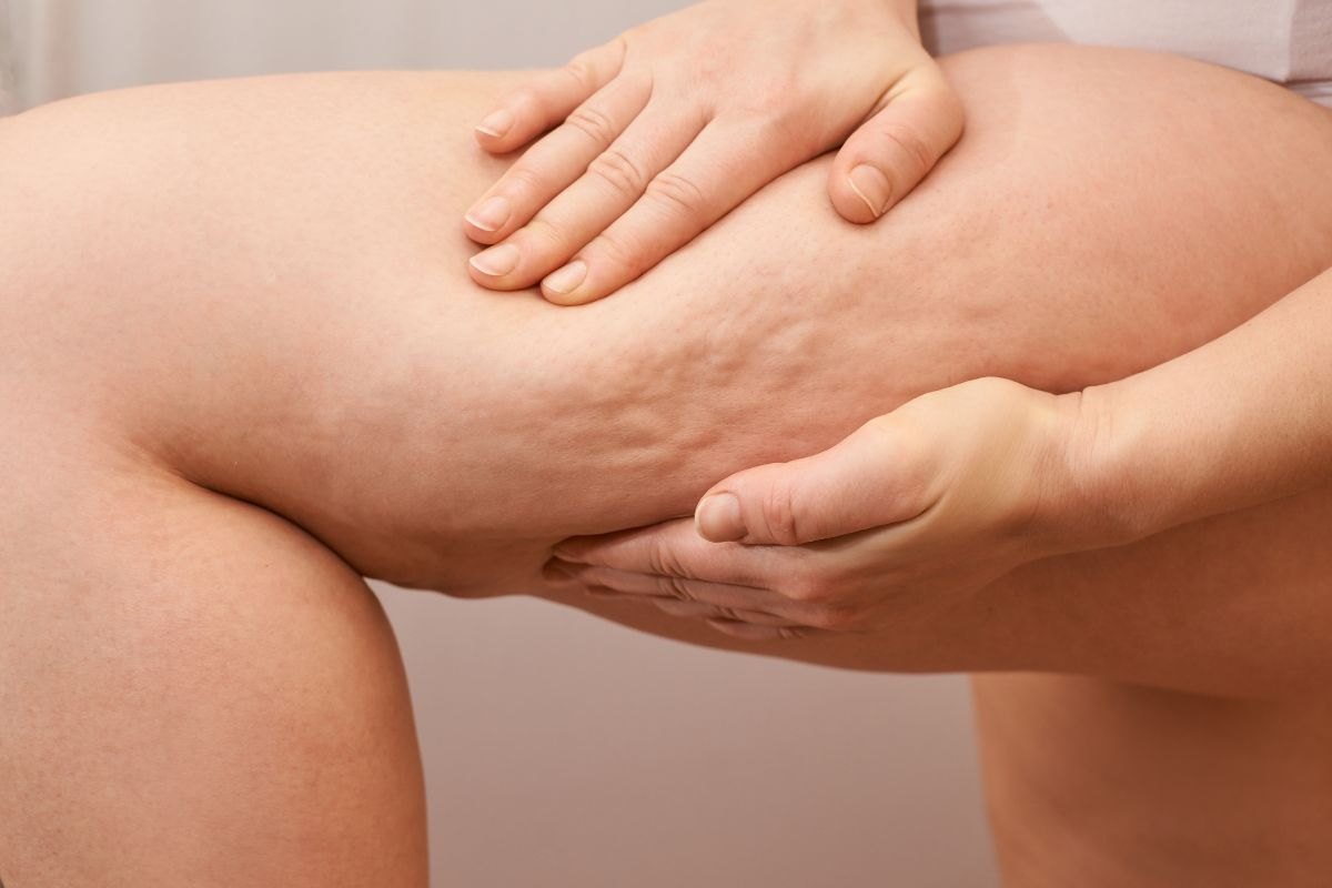 persona con cellulite