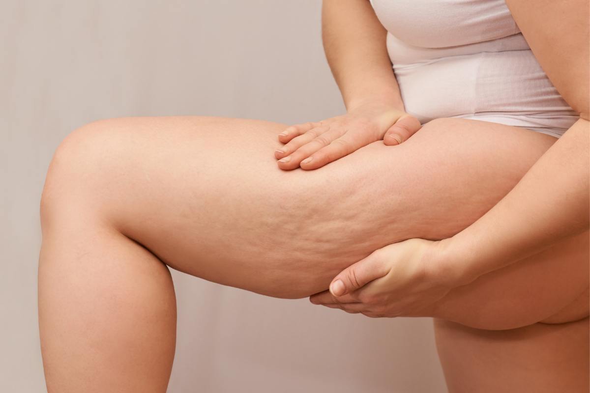 Donna che ha la cellulite