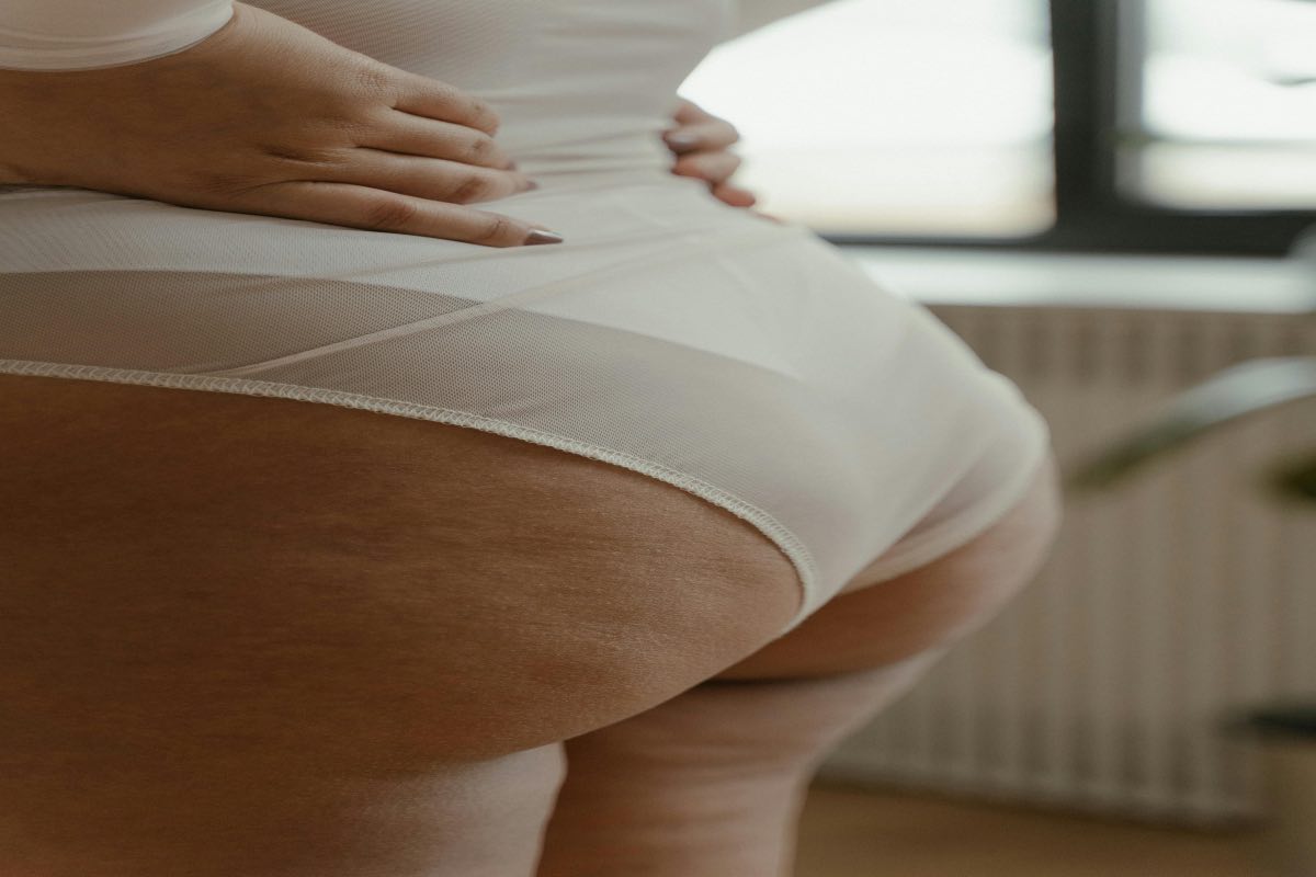 Donna con cellulite