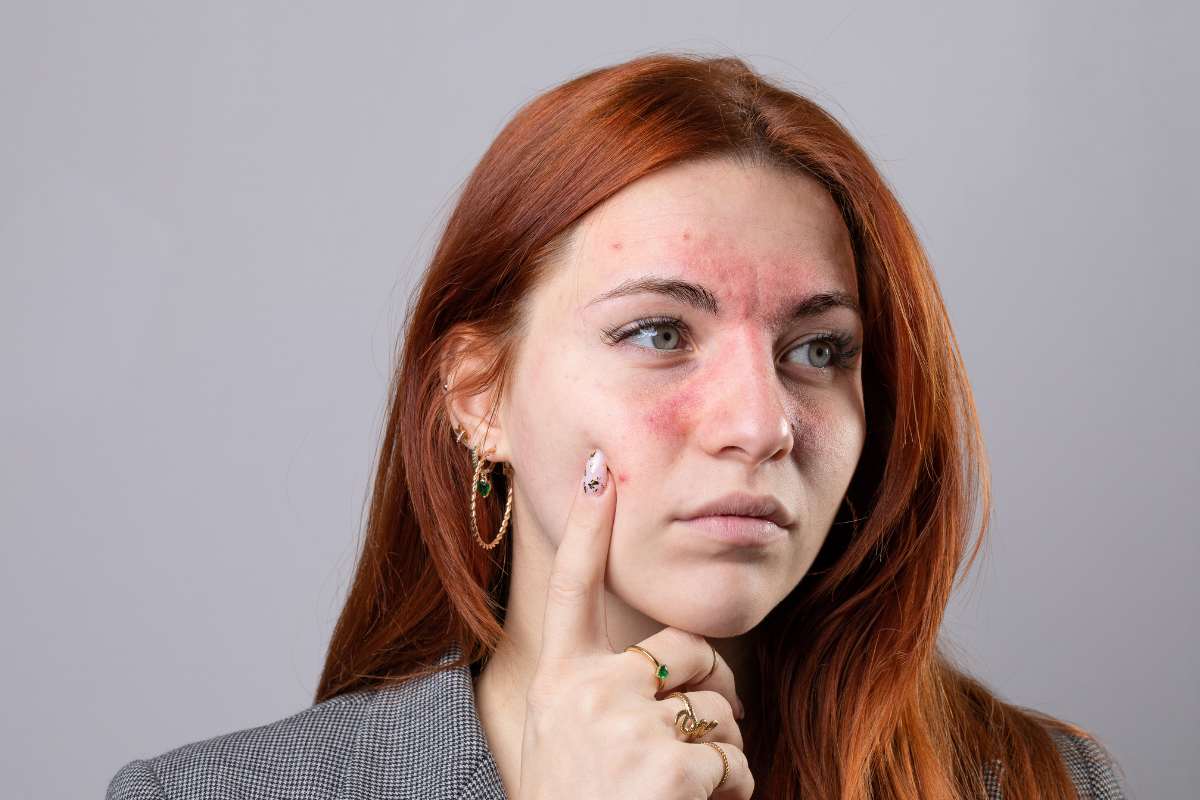 Donna con pelle del viso irritata