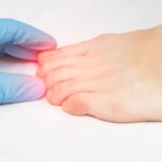 Unghia del piede con micosi