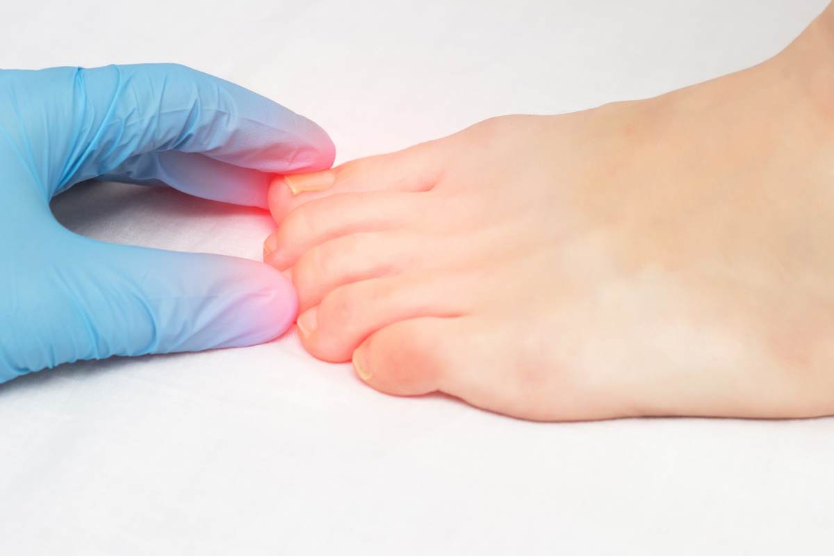 Unghia del piede con micosi