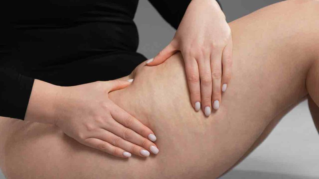 cellulite edematosa