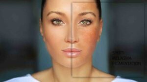 melasma