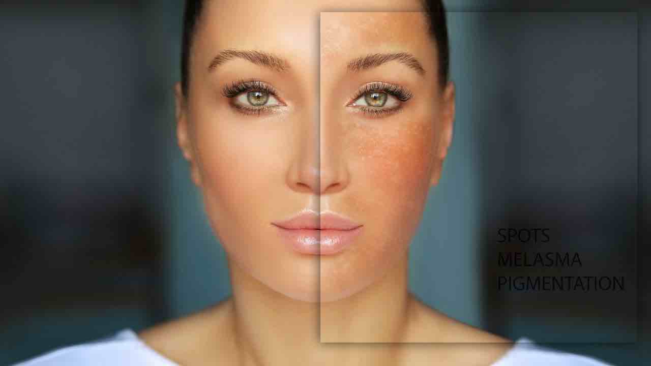melasma