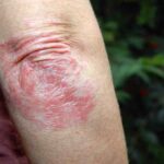 psoriasi