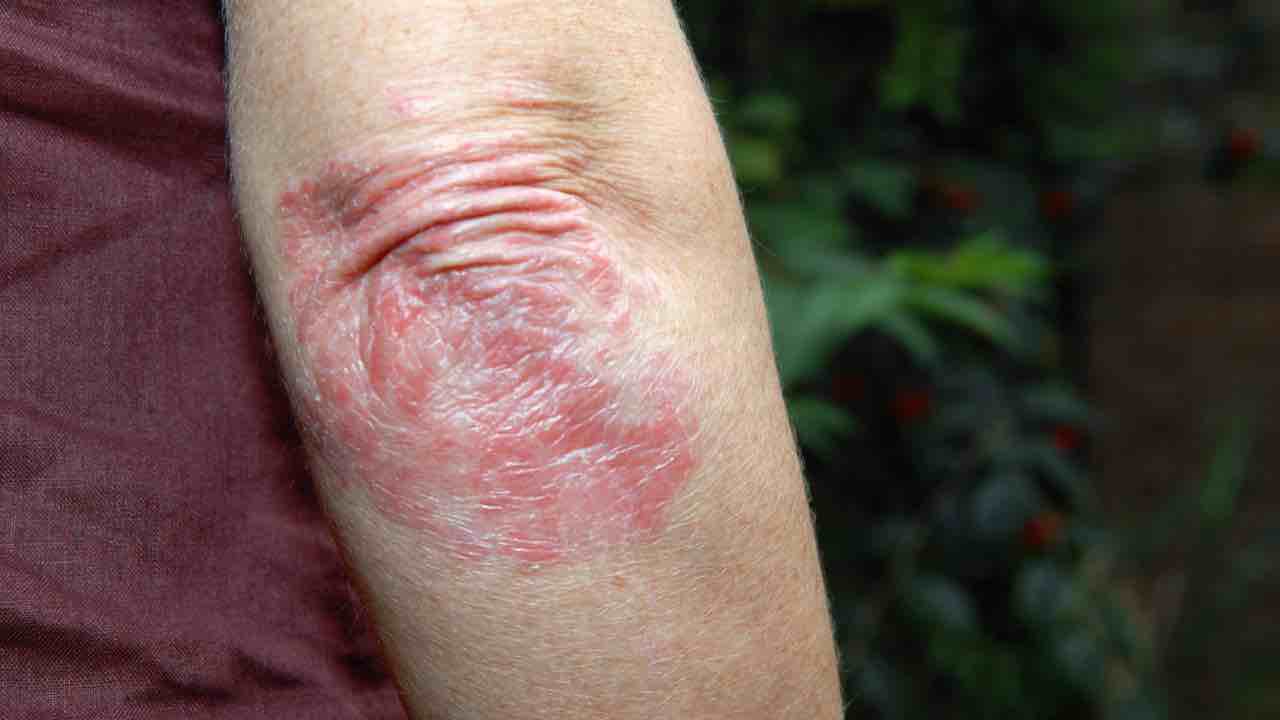 psoriasi