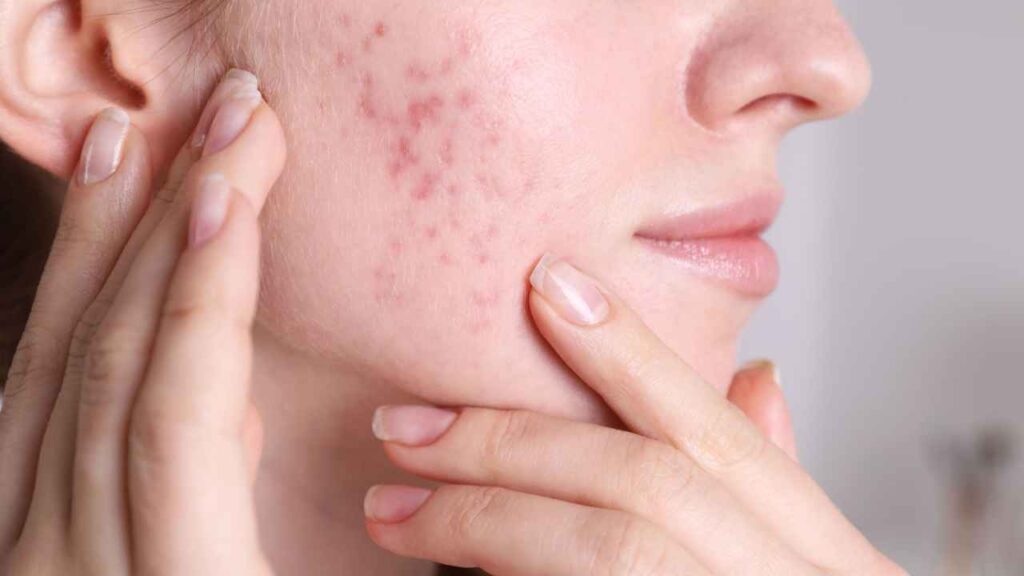 Acne viso quali creme non usare - Pourfemme.it