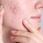 Acne viso quali creme non usare - Pourfemme.it