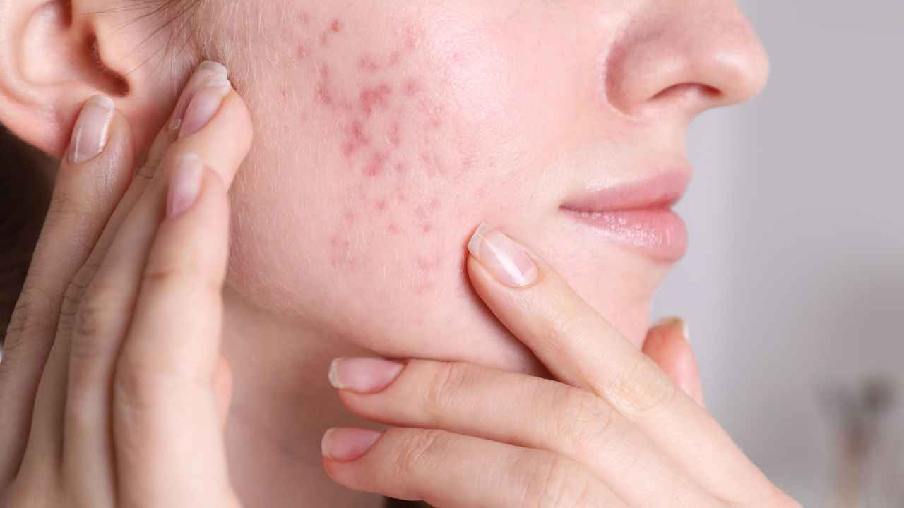 Acne viso quali creme non usare - Pourfemme.it