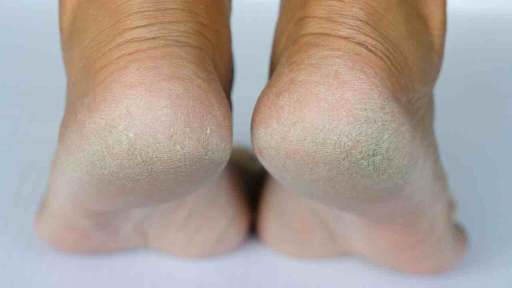 piedi secchi