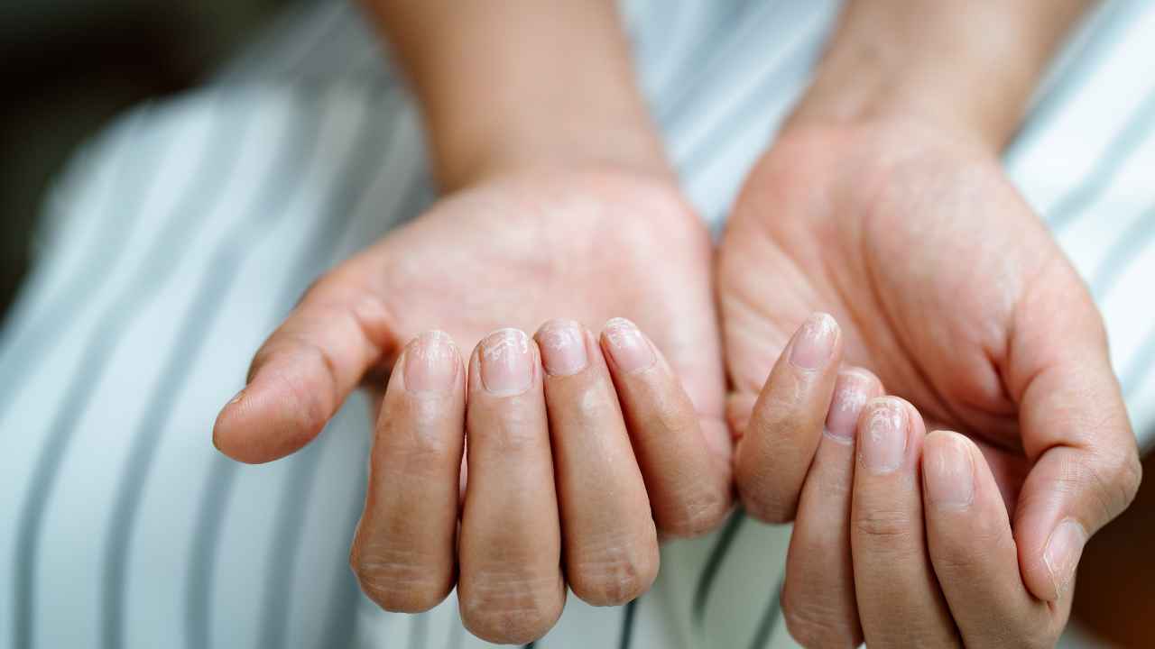 Funghi nelle mani come toglierli con l'acqua ossigenata - Pourfemme.it