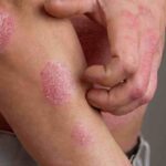 psoriasi stress