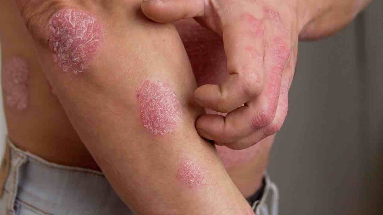 psoriasi stress