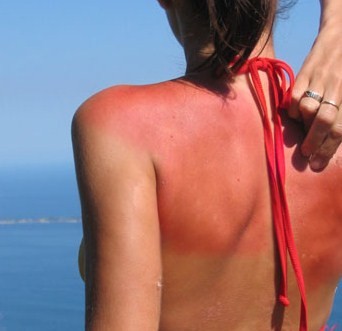 abbronzatura curare le scottature