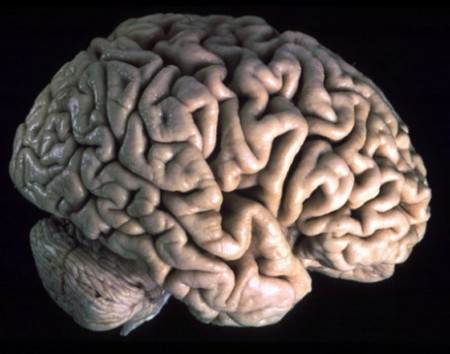 tumore al cervello glioma
