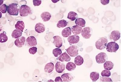 Leucemia infantile molecola