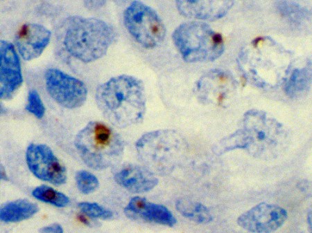 papilloma virus tumori hpv dna test