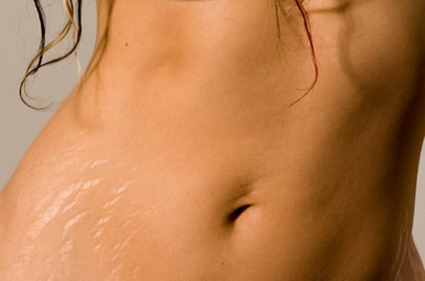 Smagliature: come prevenirle e curarle