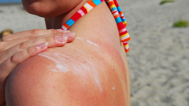Eritemi scottature prevenzione