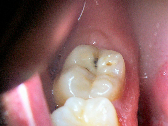 carie su un dente