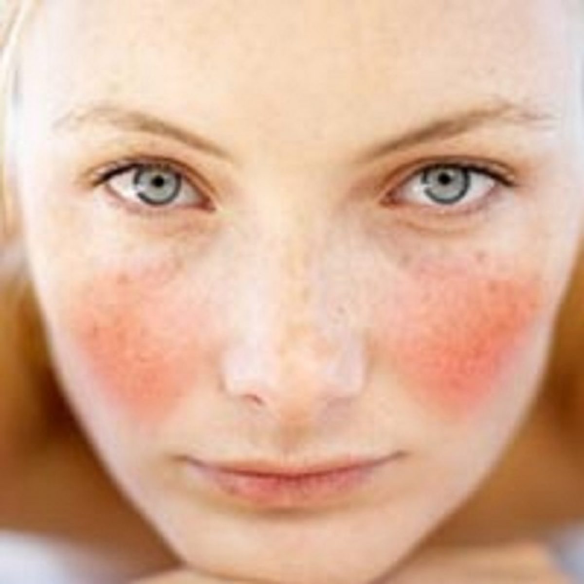 couperose rosacea rimedi naturali couperose rosacea rimedi naturali
