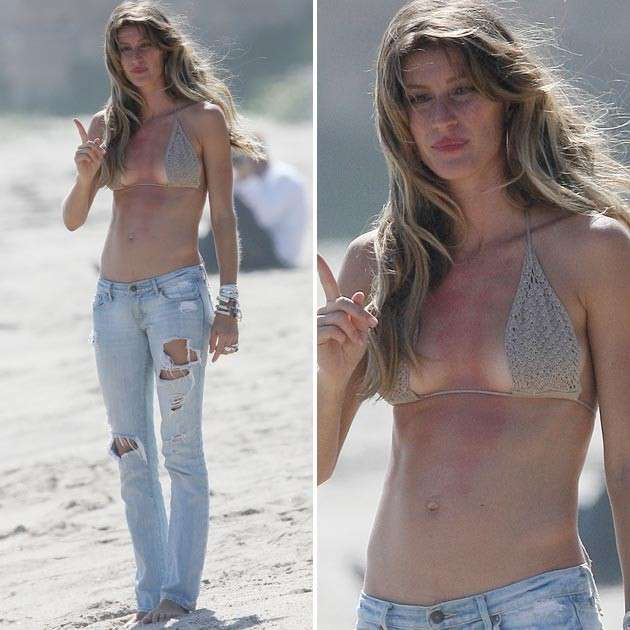 Gisele Bundchen e le scottature