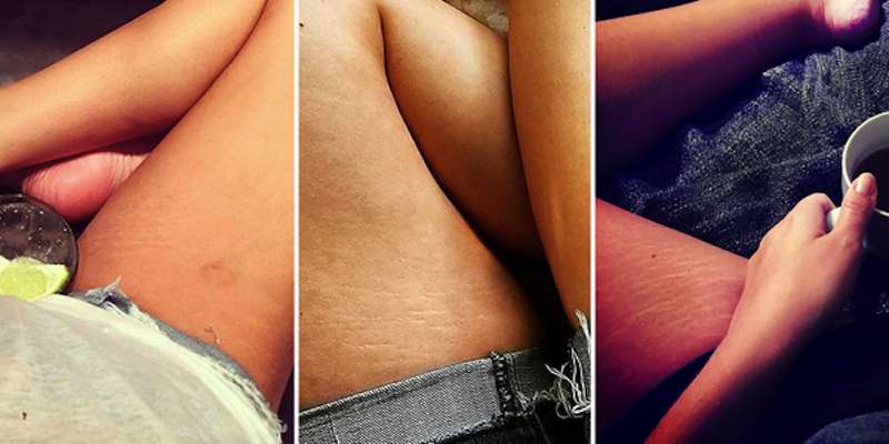 Smagliature sui social ThighReading