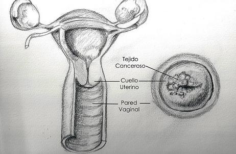 tumore collo utero