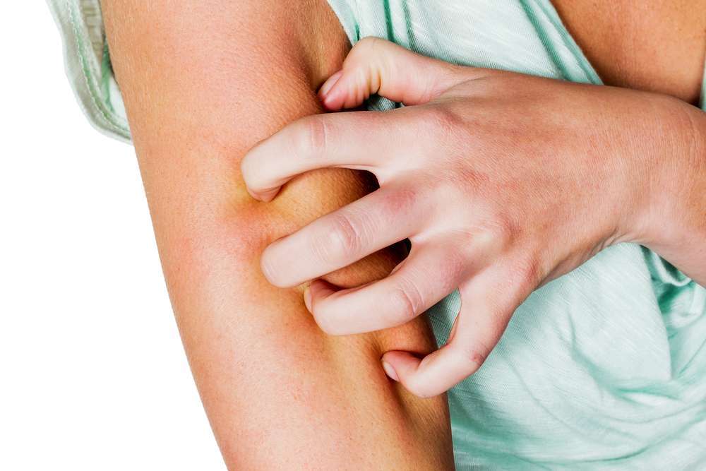 Puntura di pulce effetti rimedi e terapia