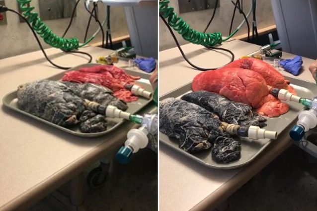 polmoni sani vs polmoni fumatore