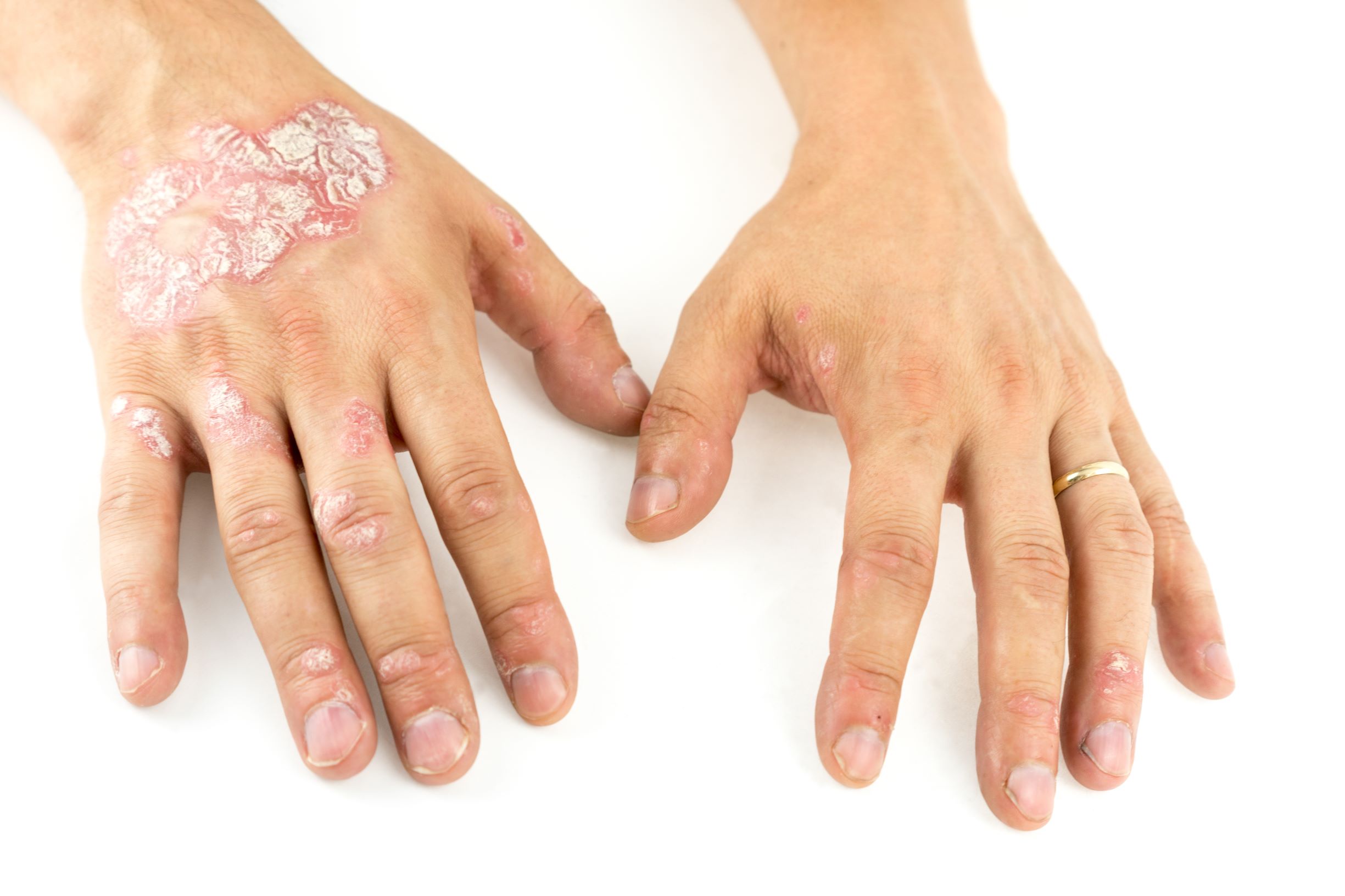 cure psoriasi 2019 cure psoriasi 2019