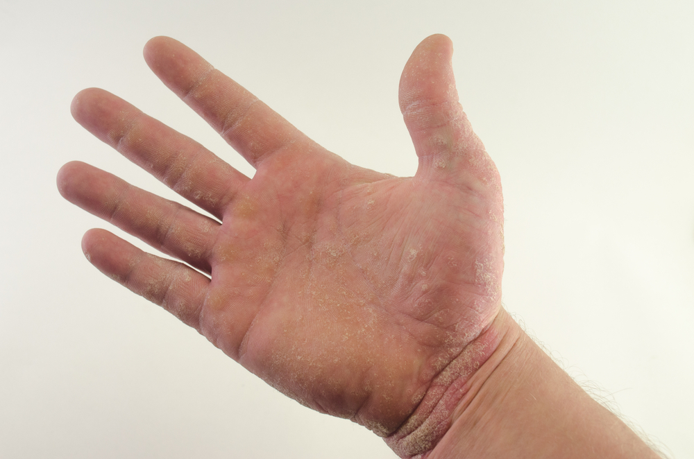 Psoriasi inversa