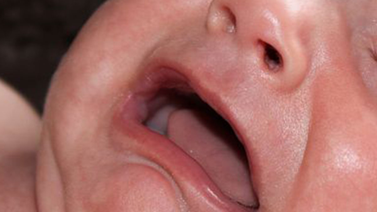 neonato